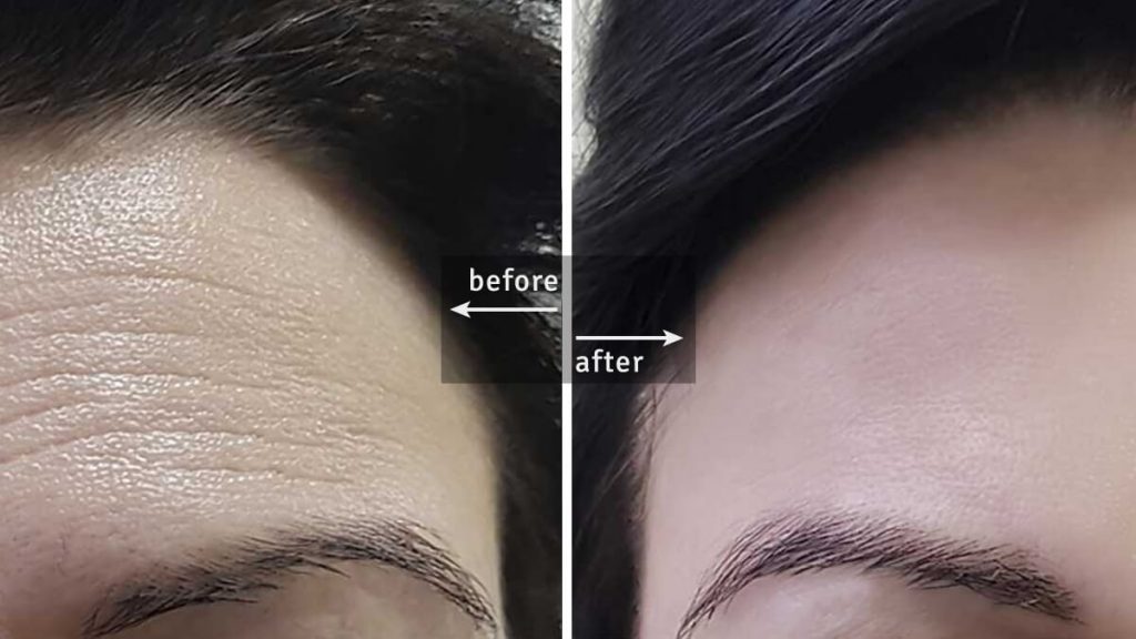 Botox Injections - Before and After The Procedure