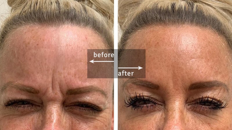 Botox Before-and-After Injection