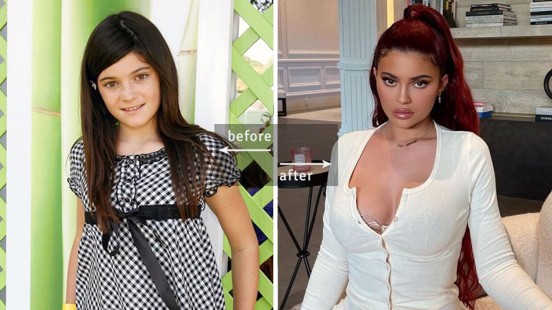 Kylie Jenner: Before and After