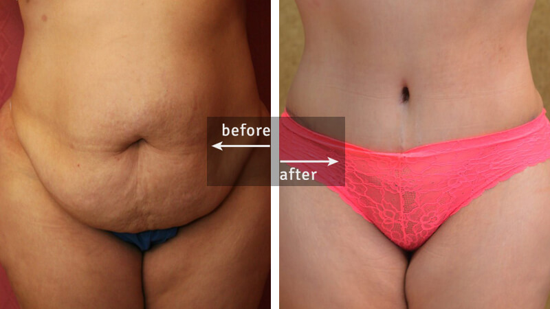 Tummy Tuck Plastic Surgery Before & After