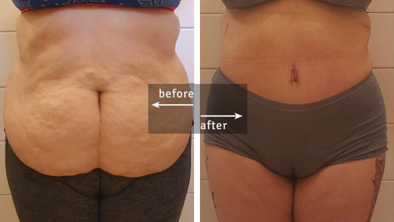 Tummy Tuck Plastic Surgery Before & After