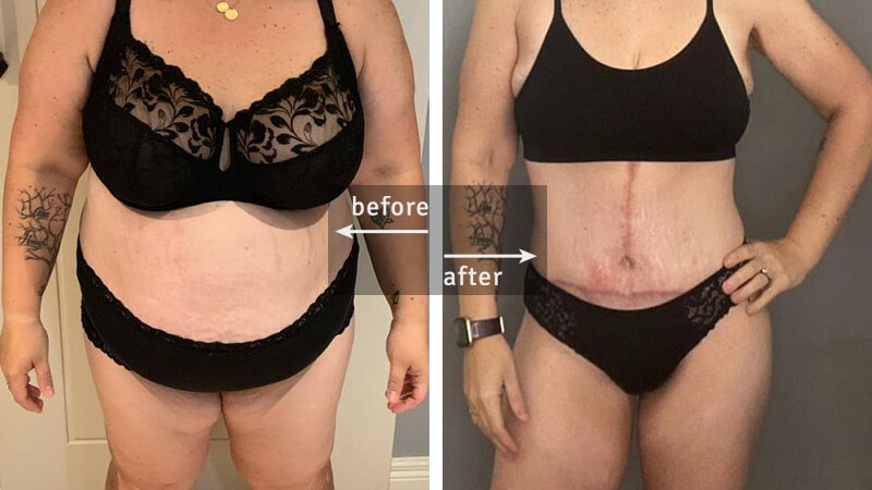 Tummy Tuck Plastic Surgery Before & After