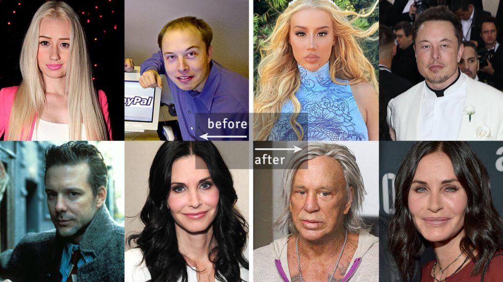 Celebrities Before & After Plastic Surgery