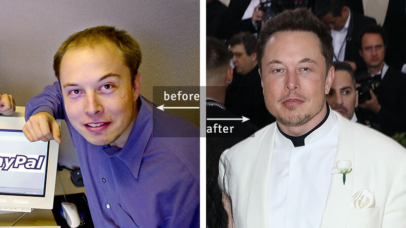 Elon Must Before-and-After Plastic Surgery