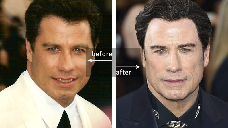 John Travolta Before-and-After Plastic Surgery