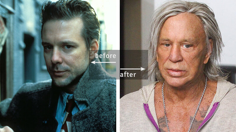 Mickey Rourke Before-and-After Plastic Surgery