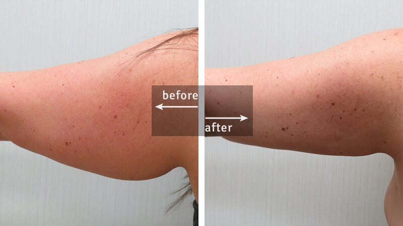 Arm Liposuction Before and After