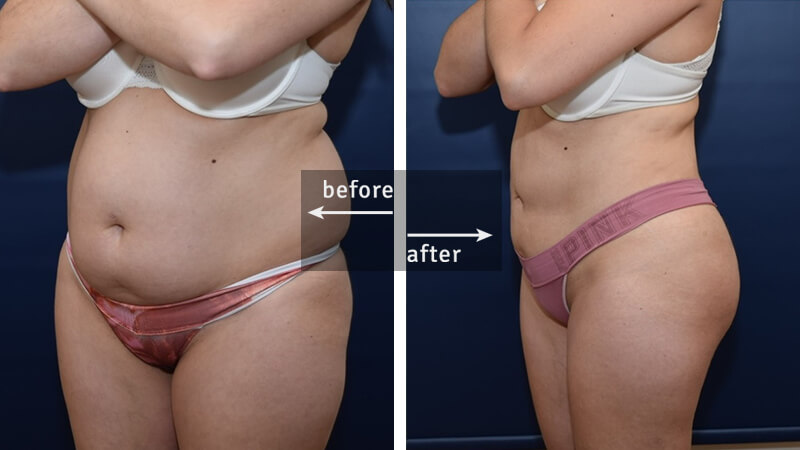 Butt Lift and Liposuction Before and After