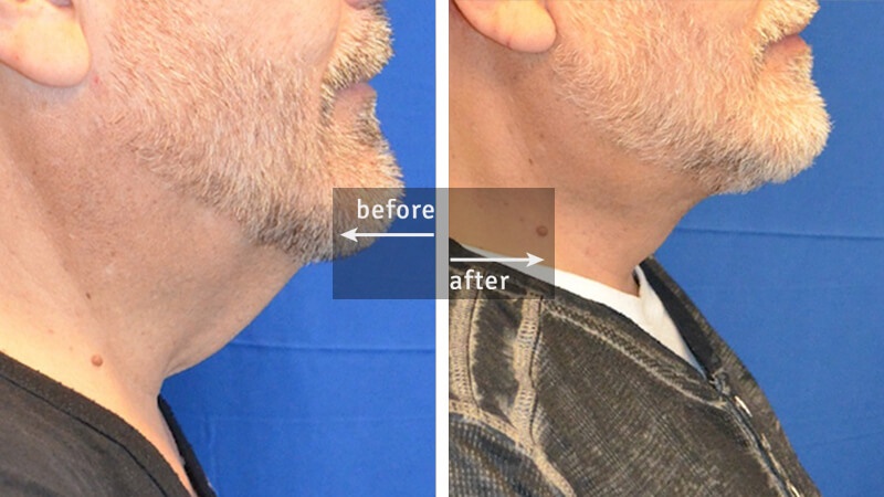 Chin Liposuction Before and After