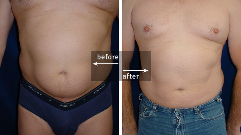 Ultrasound Liposuction Before and After